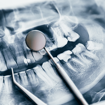 The link between oral health and systemic diseases 4 Photo of x-ray of teeth with dental tools on top, representing systemic diseases