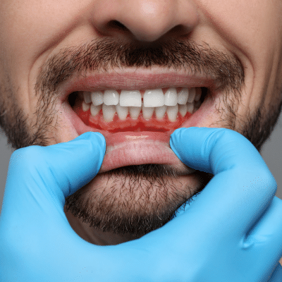 How to prevent gum disease 13 Hand wearing a blue medical glove holding down a man's bottom lip, showing red gums, representing how to prevent gum disease