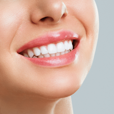 Which is the best teeth whitening method? Professional whitening vs. At-home kits? 12 Close-up of a woman's smile, showing white teeth, representing best teeth whitening method